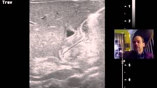 Pyloric Stenosis Ultrasound DISCUSSION 1 [upl. by Notgnirrac]