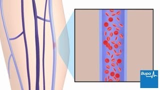 Abscess Deep to Superficial Phlebitis [upl. by Mailiw]