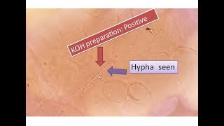 KOH positive  Fungal elements seen  Sputum  hyphae [upl. by Lorri]