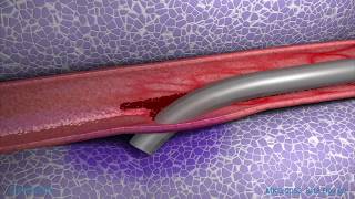 Peripheral IV Infiltration Animation [upl. by Ahouh179]