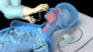 Nasotracheal suctioning NTS  3D animation [upl. by Orel]