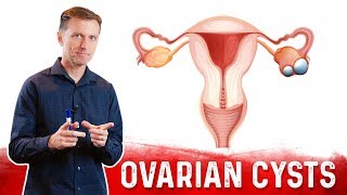 Ovarian Cysts Causes Symptoms amp Natural Treatment – DrBerg [upl. by Louanne8]