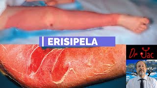 Erisipela [upl. by Eldrid]