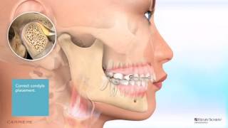 Carriere® Motion™ Appliance for Class II Patient Education Animation [upl. by Sjoberg]