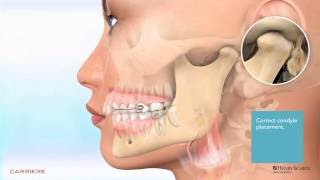 Carriere® Motion™ Appliance for Class II Patient Education Animation 2 [upl. by Arraek]