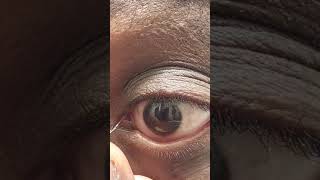 Stringy Mucus Eye Fishing Syndrome Eye Gunk Removal [upl. by Kenzi]