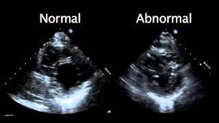 Echocardiogram from the Patient Compared with That from a Normal Control  NEJM [upl. by Doley]