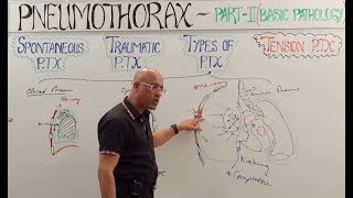 Tension Pneumothorax  Diagnosis amp Management🩺 [upl. by Omarr]