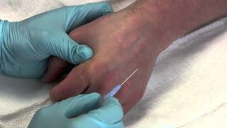 Intravenous Catheter Placement [upl. by Tuckie545]