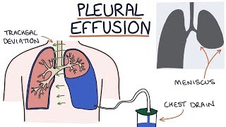 Understanding Pleural Effusions [upl. by Jory]