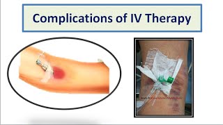 Complications of IV Therapy [upl. by Strage]