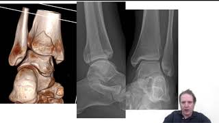 case takeaway  maisonneuve ankle fracture and medial deltoid ligament injury  Lyndon Mason [upl. by Omsoc]