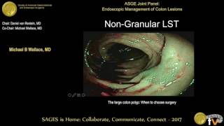 The large polyp When to choose EMR ESD surgery [upl. by Peyton500]