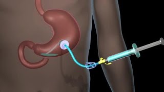 Nursing NG Tube Bolus Feeding Demonstration [upl. by Lorrin]